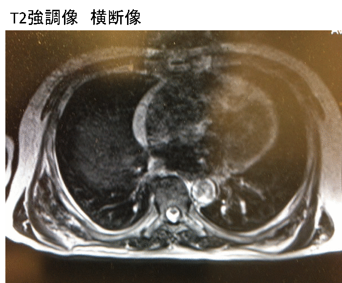elastofibroma MRI findings1