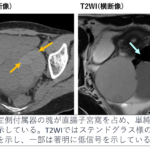 画像診断 : 超音波,CT,MRIを中心とした鑑別診断 : 腫瘍 肝血管腫の病態と画像診断（CTを中心に） - YouTube