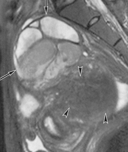 adenomyotic cyst=cystic adenomyosis