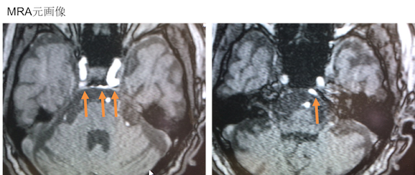 内頸動脈海綿状脈洞瘻(CCF)後方型のMRA元画像