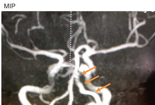 内頸動脈海綿状脈洞瘻(CCF)後方型のMRAのMIP像
