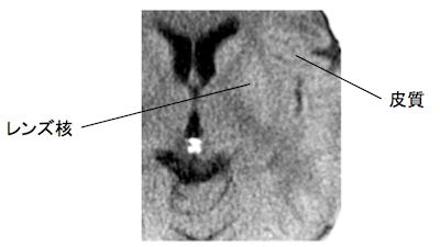 early CT sign