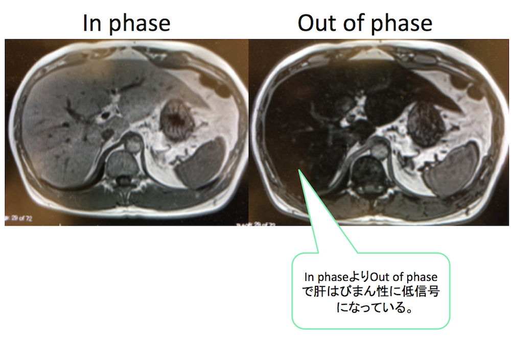 fatty-liver-mri-in-phase-out-of-phase