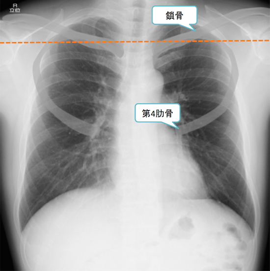 normal anatomy of chest Xray1