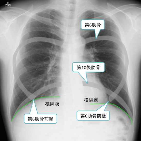 normal anatomy of chest Xray2