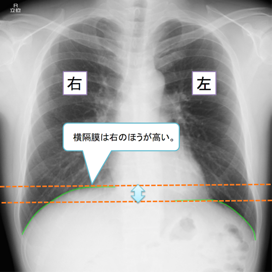 normal anatomy of chest Xray3