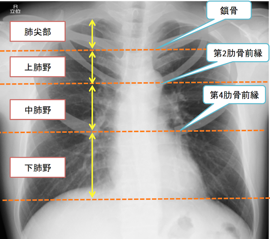 normal anatomy of chest Xray5