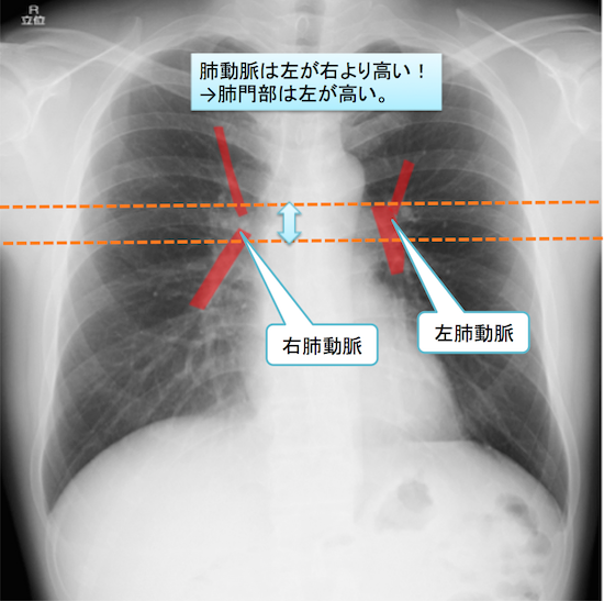 normal anatomy of chest Xray6