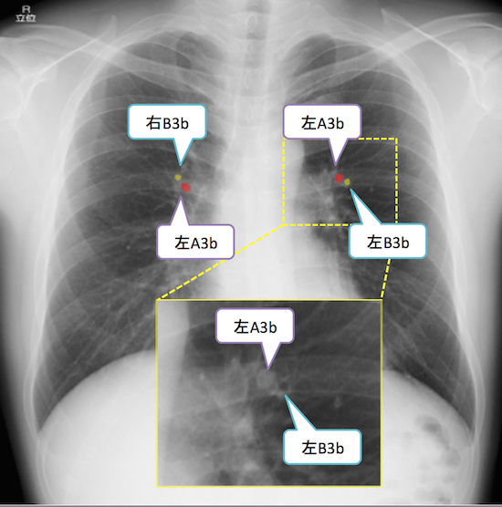 normal anatomy of chest Xray7