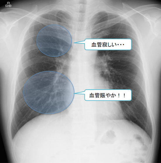 normal anatomy of chest Xray8