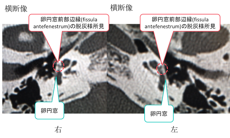 otosclerosis fenestral type CT findings1
