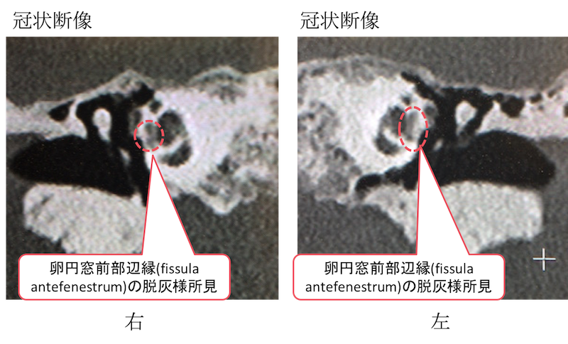 otosclerosis fenestral type CT findings2