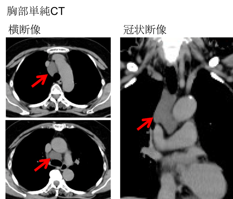 心膜洞の液貯留（心嚢液）のCT画像診断