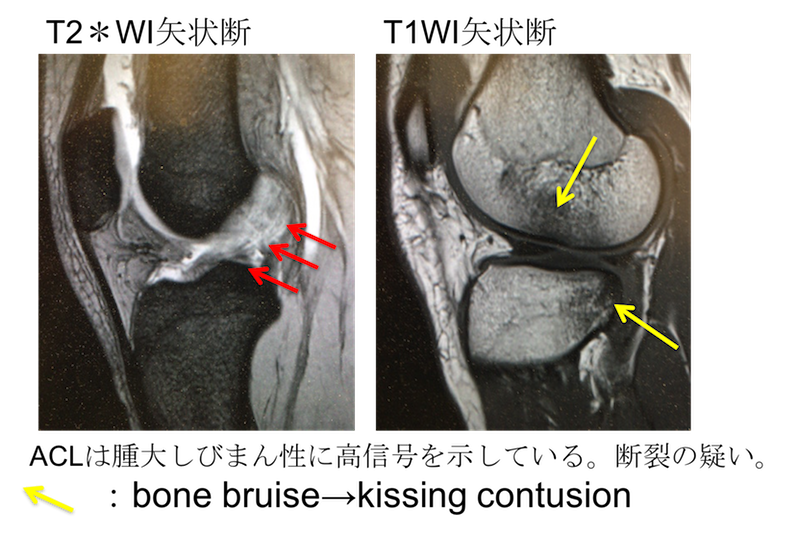 anterior cruciate ligament tear mri findings