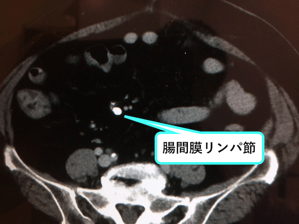 腸間膜リンパ節の石灰化のCT画像
