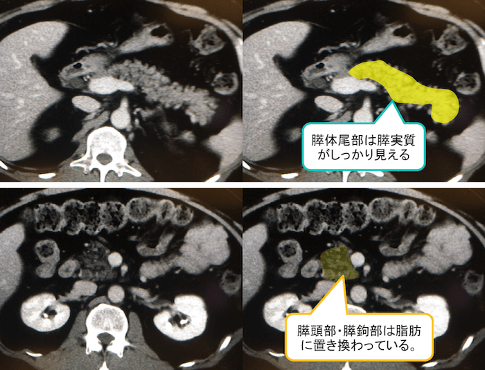 膵臓の脂肪置換のCT画像