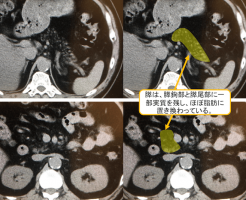 膵臓の脂肪置換のCT画像
