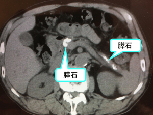 膵石のCT画像