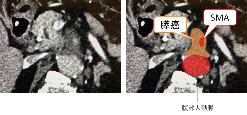 pk artery invasion ct findings