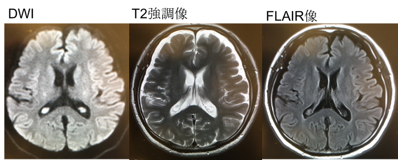 choroid plexus cyst MRI findings