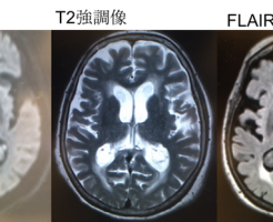 脈絡叢嚢胞の MRI 画像