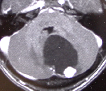 hemangioblastoma2