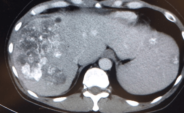 石灰化を有する転移性肝腫瘍のCT画像所見