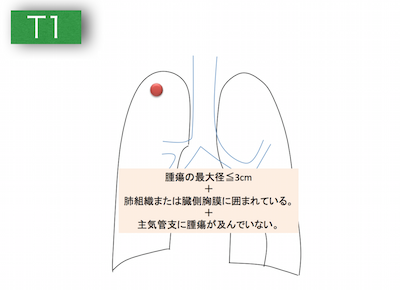 lungcancerT1