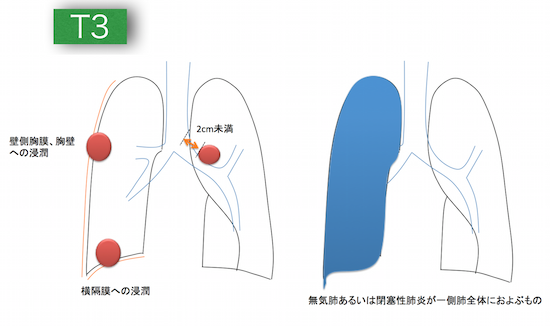 lungcancerT3