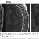 spinal-dural-arteriovenous-