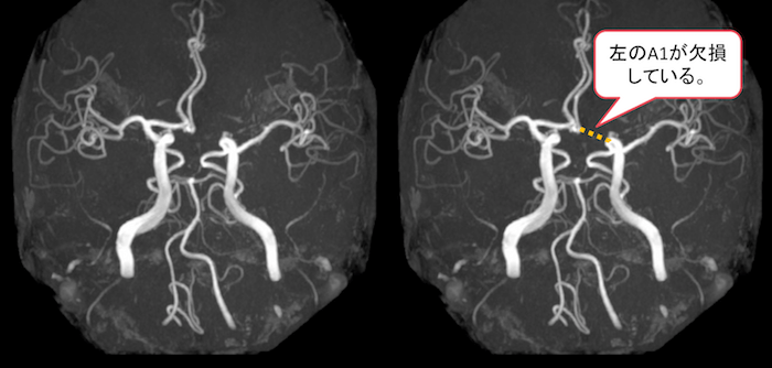 willis動脈輪のうち前大脳動脈(ACA)のA1が欠損している正常変異のMRA画像