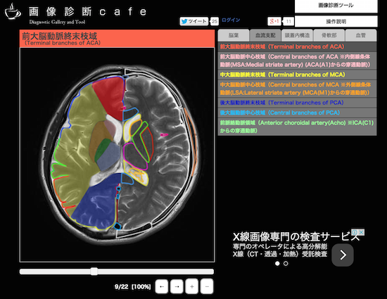 保存版】脳血管支配域と脳MRI画像の関係が一目で分かるツール！