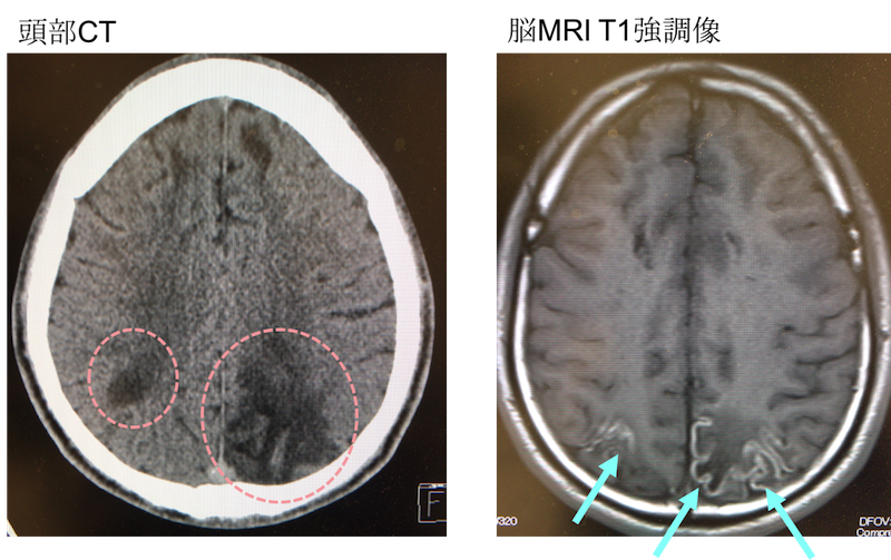 laminar necrosis MRI T1WI findings