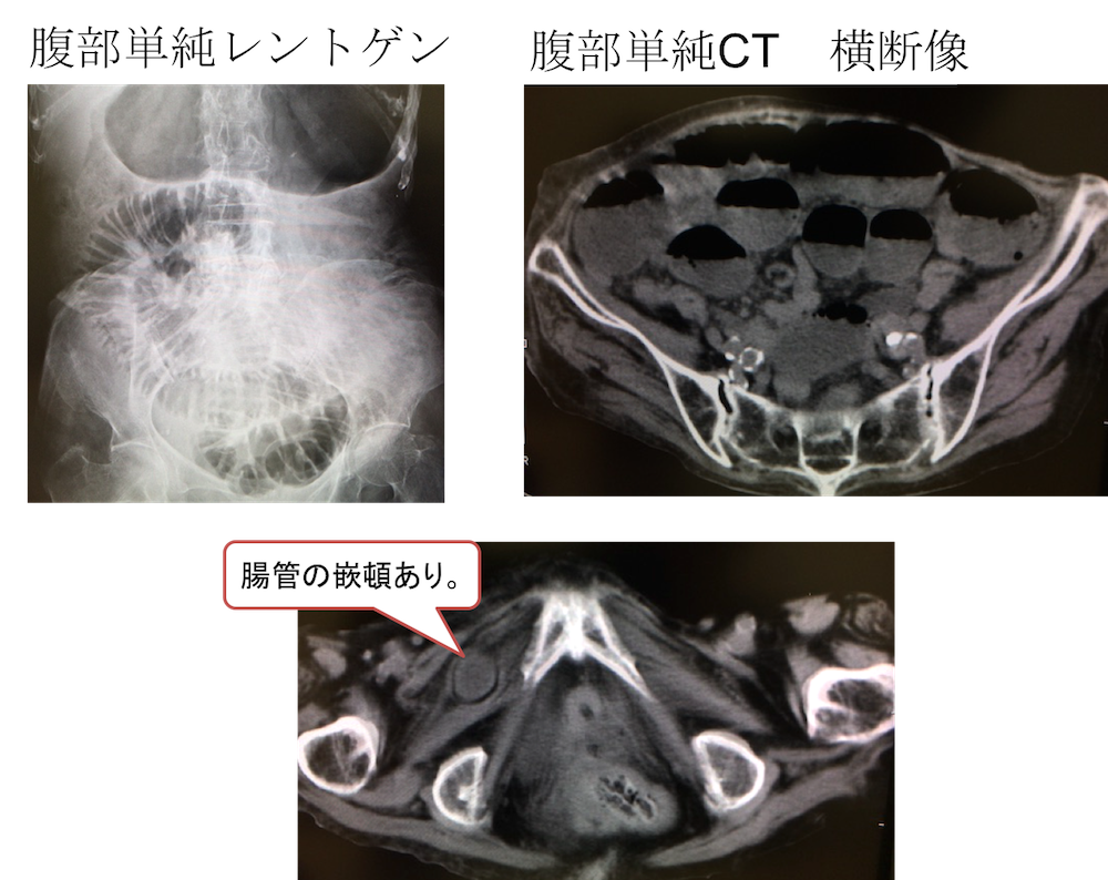 obturator hernia CT findings1