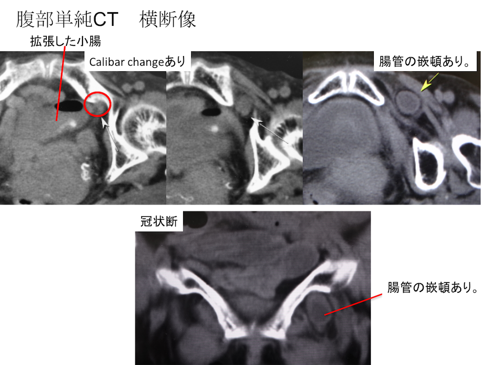 obturator hernia CT findings2