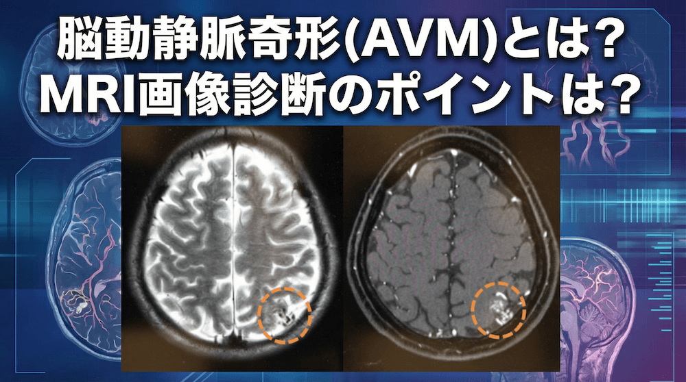 脳動静脈奇形(AVM)とは？MRI画像診断のポイントは？