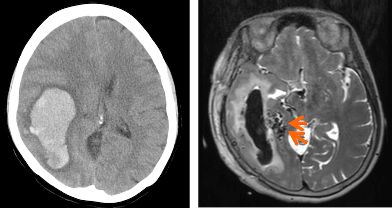 脳動静脈奇形による脳出血のCT,MRI画像