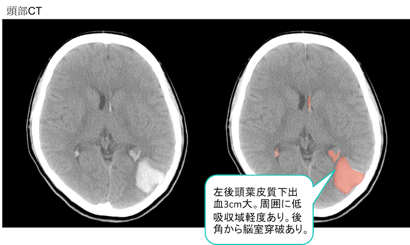 脳動静脈奇形による脳出血のCT,MRI画像
