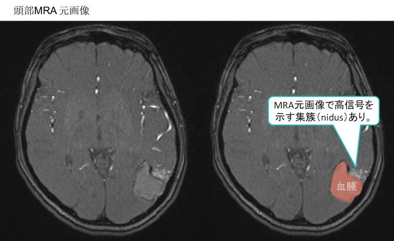 脳動静脈奇形による脳出血のCT,MRI画像