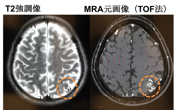 脳動静脈奇形のMRI画像