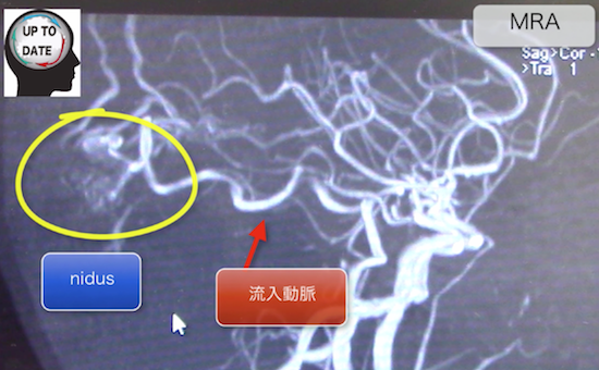 cerebral arteriovenousmalformation2
