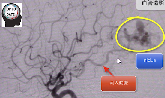 cerebral arteriovenousmalformation3
