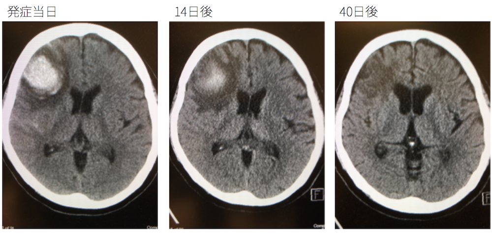 cerebral-hemorrhage-ct-findings-follow