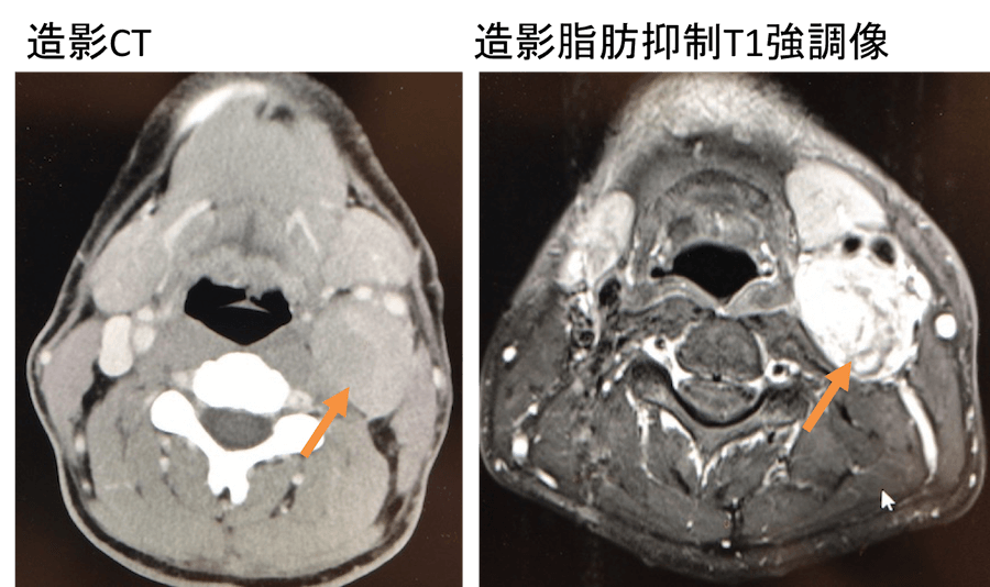 paragangliomaのCT、MRI画像