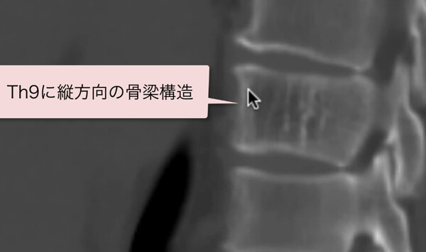 脊椎血管腫のCT画像vertebral hemangioma