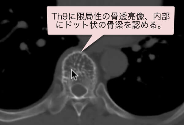 脊椎血管腫のCT画像vertebral hemangioma