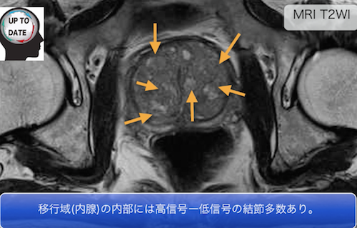 benign prostatic hyperplasia1