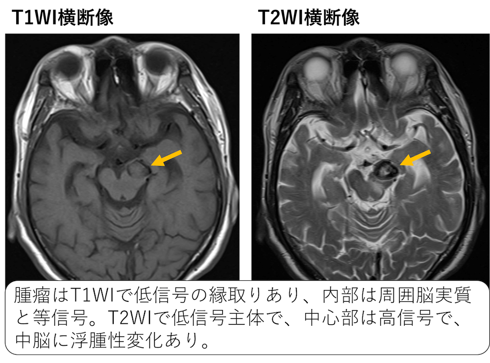 前大脳動脈瘤・椎骨脳底動脈瘤(ACA・VBA Aneurysm)のすべて シミ