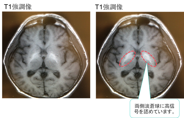 hepatic encephalopathy MRI findings1