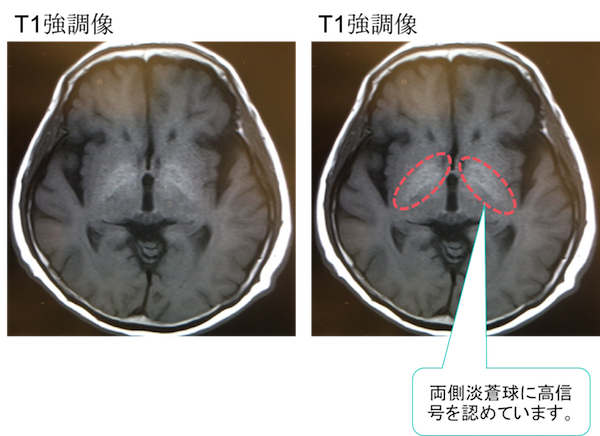 hepatic encephalopathy MRI findings2